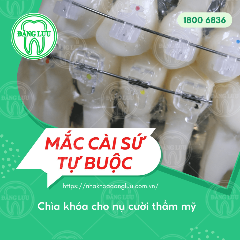Niềng răng mắc cài sứ tự đóng